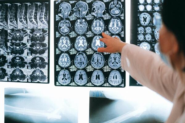 Using the COmplex PAthway SImulator, Stage Analysis, and Chemical Kinetics to Develop a Novel Solution to Lower Tau Concentrations in Alzheimer’s Disease