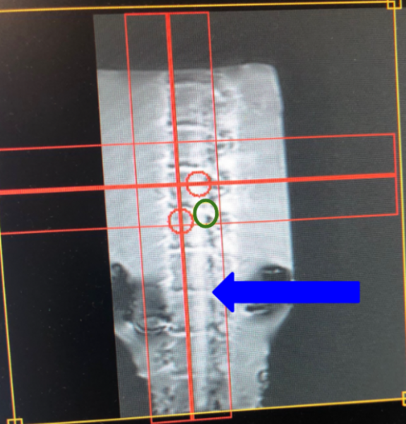 Utilizing a novel T1rho method to detect spinal degeneration via magnetic resonance imaging