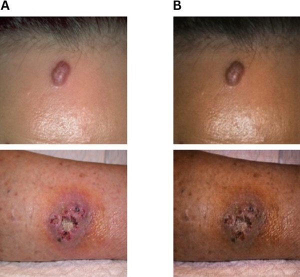 Mitigating skin color bias in dermatology AI using CycleGAN-based data augmentation