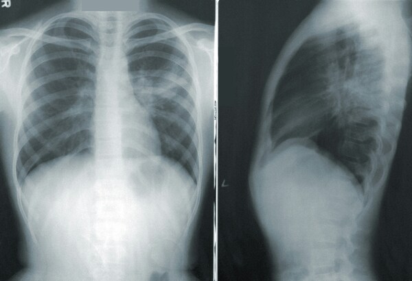 Lung region complexity affects Grand-CAM and Deep Taylor outcomes in pneumonia predictions