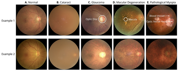 Retinal biomarkers for the detection of neurological disease using deep learning